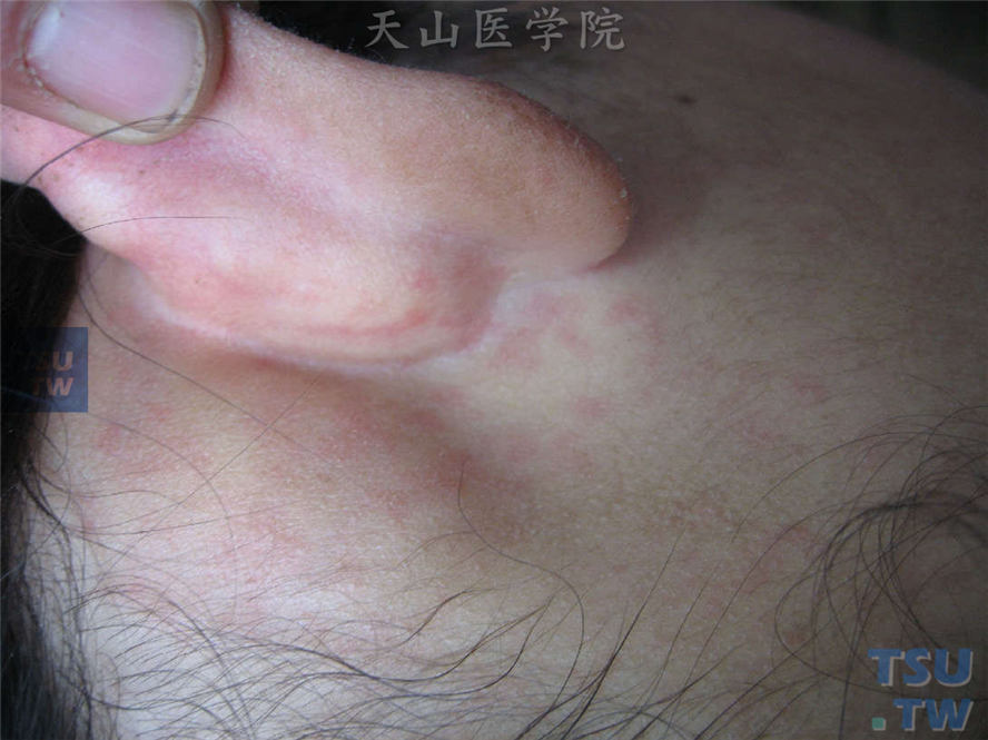 风疹（rubella，german measles）症状表现