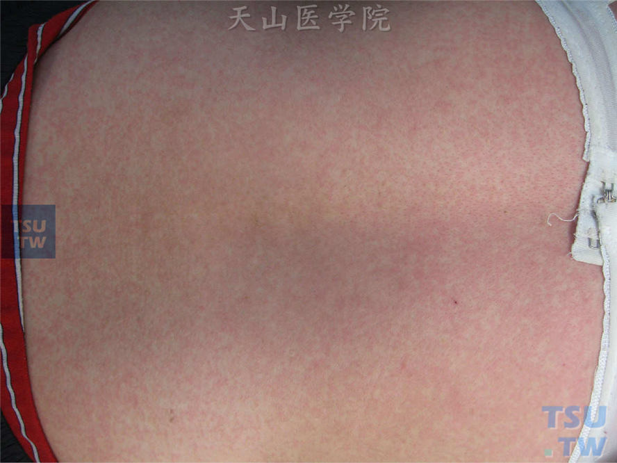 同一病人，后背部淡红色细点状斑疹，疹间可见正常皮肤