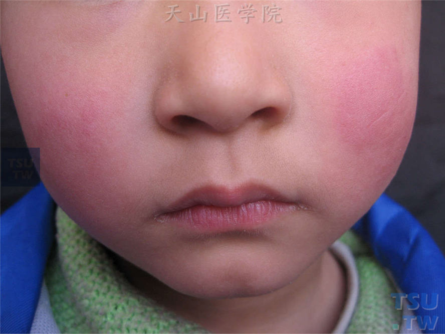 患儿两侧面颊部玫瑰色水肿性红斑，边界清楚