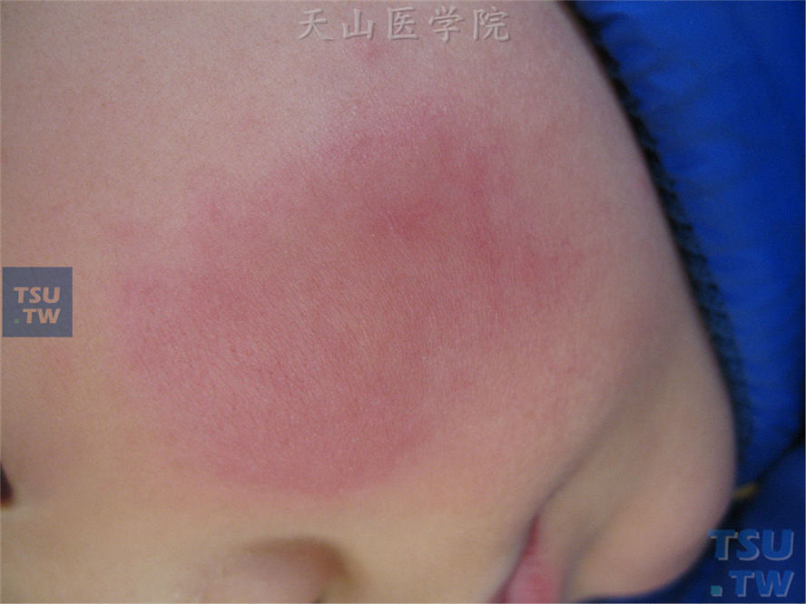 同一患儿，侧面观，颊部边界清楚的水肿性红斑