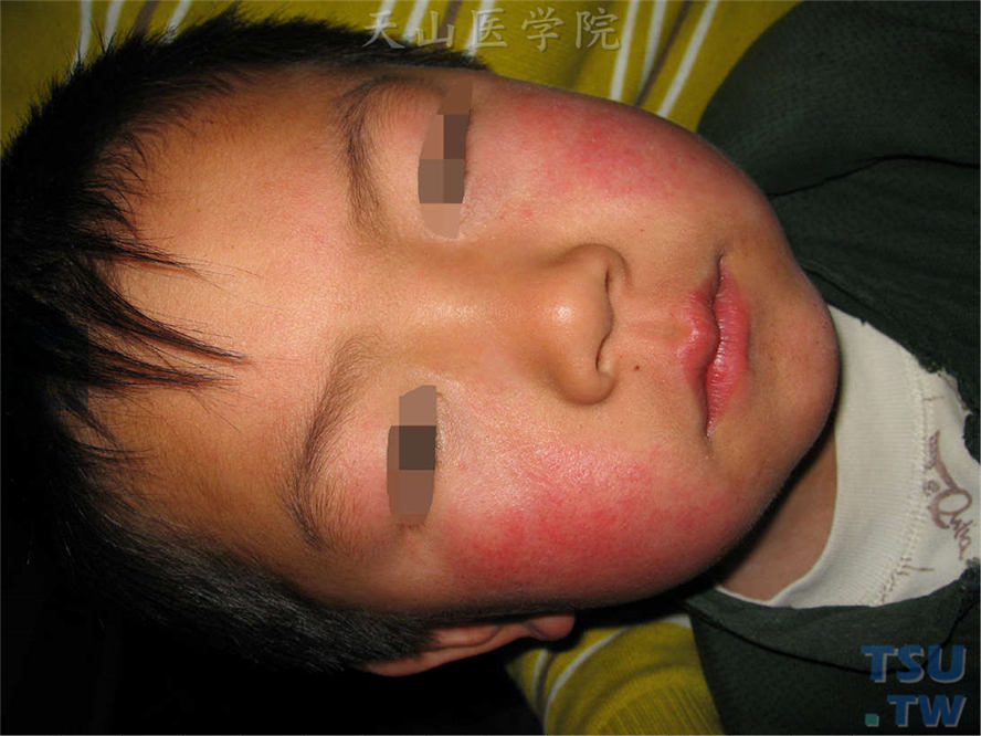 患儿两颊部对称性玫瑰色红斑，无鳞屑，边界清楚