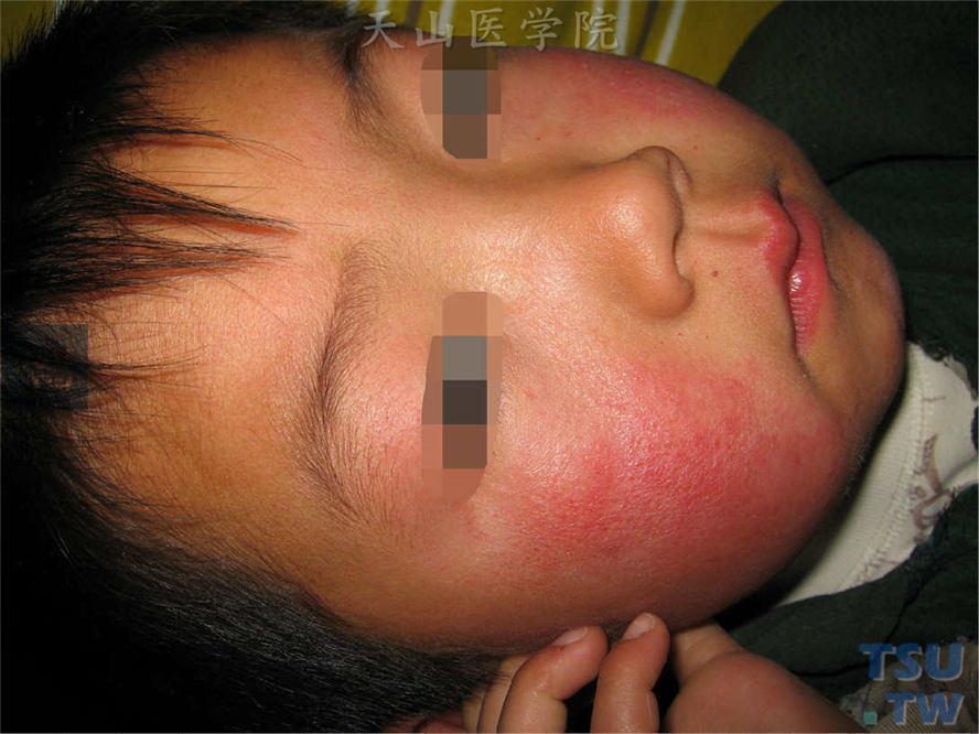 传染性红斑（erythemainfectiosum）症状表现