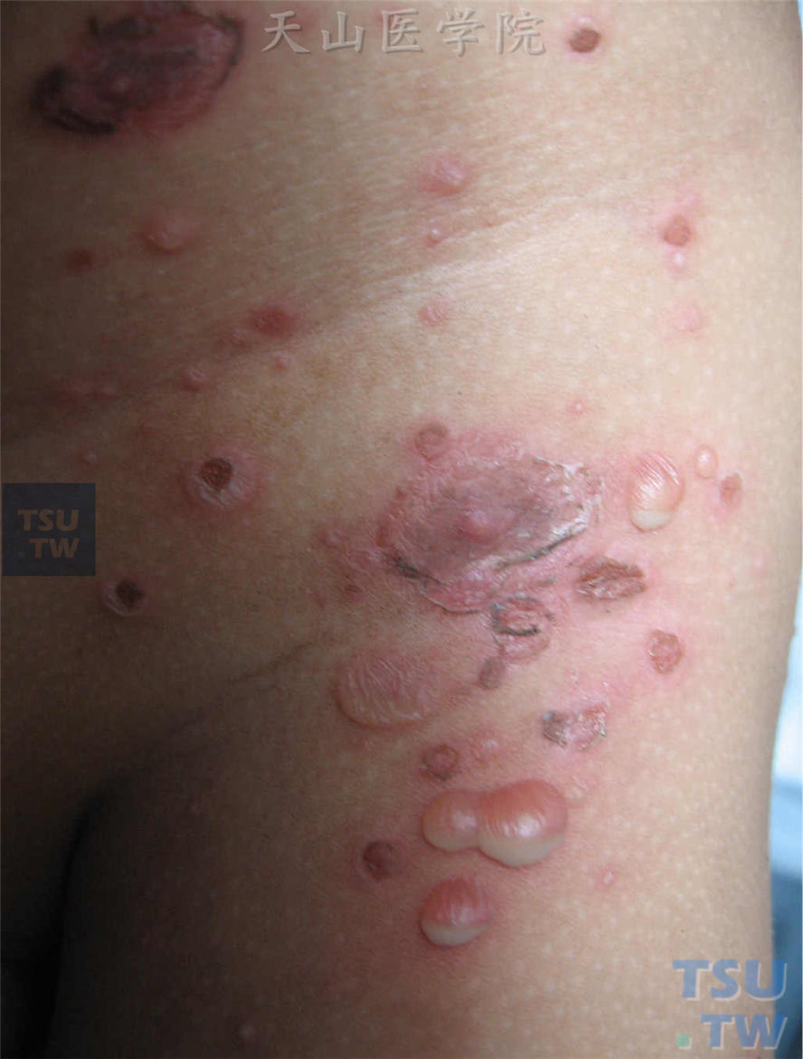 大疱性脓疱疮：水疱相互融合成大疱，疱内半月状积脓，破溃后形成糜烂面