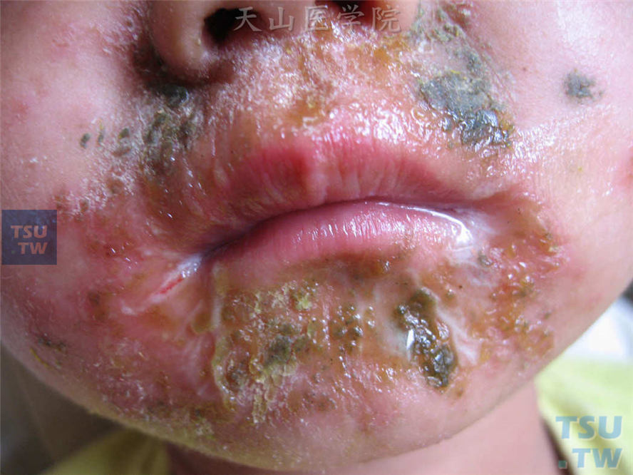 脓疱疮：葡萄球菌性烫伤样皮肤综合征（SSSS）症状表现