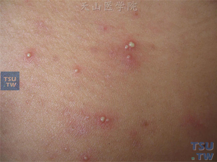 毛囊性脓疱疮（follicular vulgaris）的症状表现