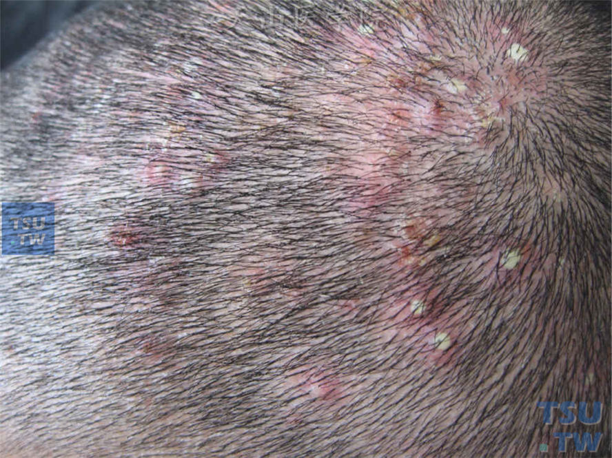 毛囊炎：局限于毛囊口的化脓性炎症。头皮密集毛囊性炎性丘疹，中央脓疱，周围红晕