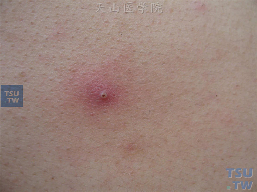 毛囊性炎性丘疹，中央脓疱