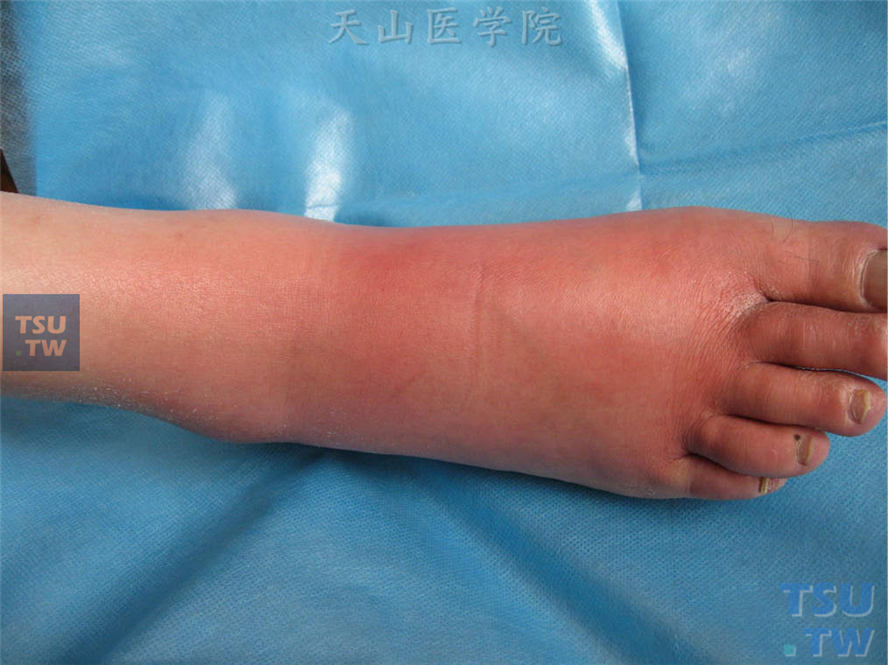 右足趾、足背水肿性红斑，表面紧张发亮，皮温增高，触痛明显，有足癣病史