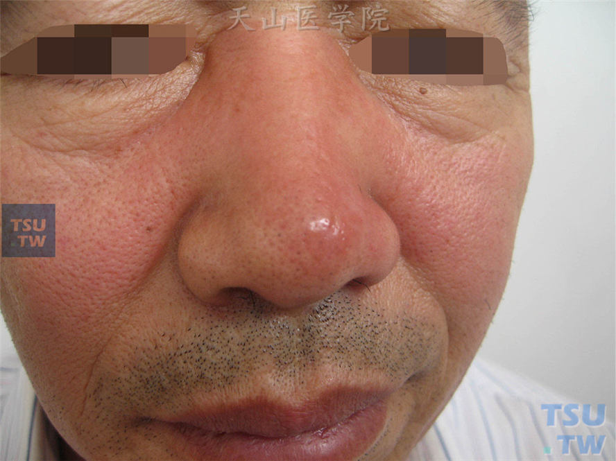 抠鼻后引起以鼻部为中心面中部水肿性红斑，表面皮温增高，触痛明显