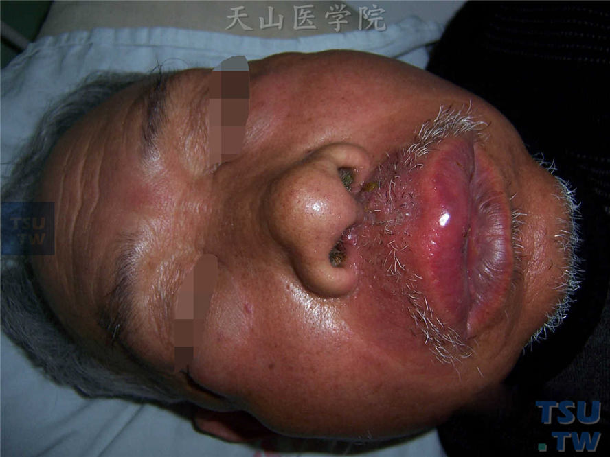 面部弥漫性红肿性斑块，基底浸润，边界不清，中央红肿明显，伴有疼痛、发热和全身不适
