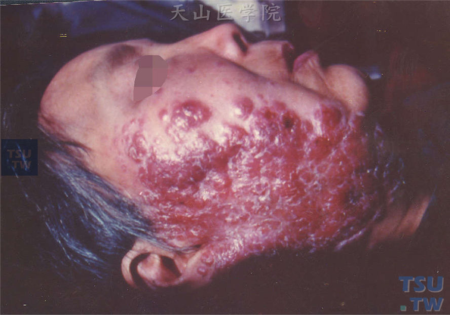 皮肤结核病：寻常狼疮（Lupus vulgaris）症状表现