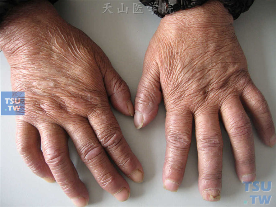 瘤型麻风：同一病人，手部畸形