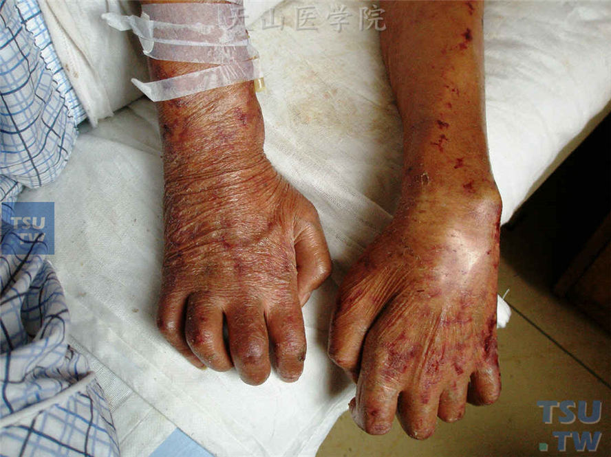 瘤型麻风：同一病人，手部畸形