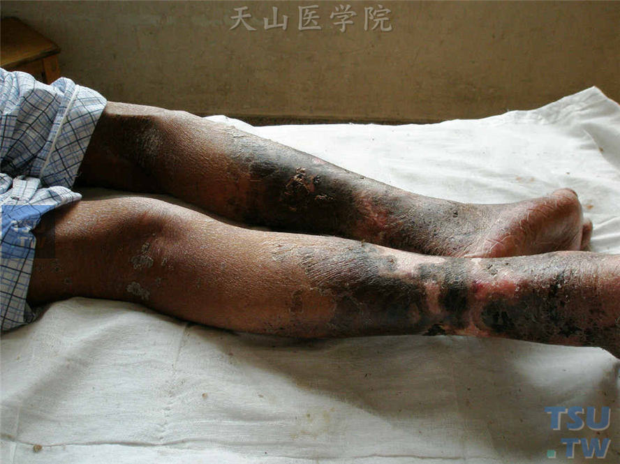 瘤型麻风：双踝部皮肤弥漫性肿胀，皮肤粗糙，可见淡褐色鳞屑，右足跟可见糜烂水疱皮损。