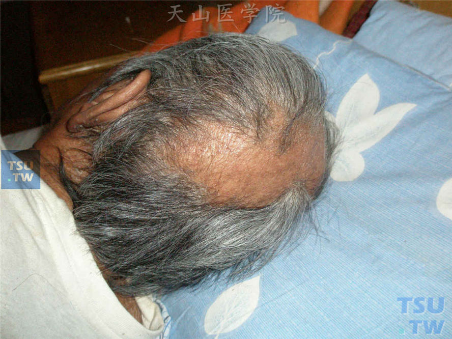 瘤型麻风：病人头发稀疏，并出现片状头发脱落区