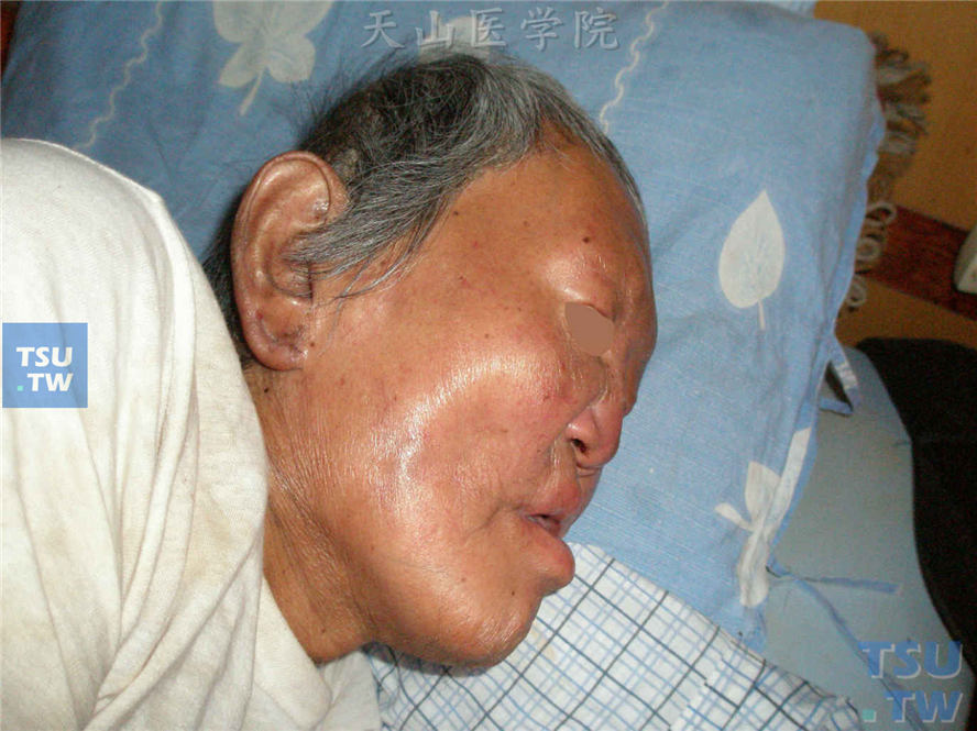 瘤型麻风：病人口唇肥厚