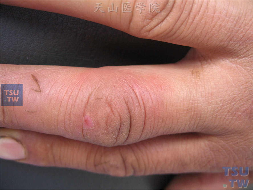 类丹毒：右手中指背侧局限性紫红斑，可见手指划伤的痕迹