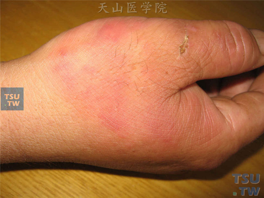 类丹毒：右手拇指、手背及虎口处紫红斑，可见拇指划伤的结痂