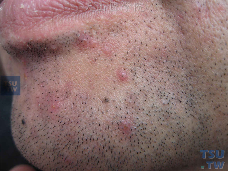 胡须部位毛囊性炎性丘疹、丘脓疱疹，中央有胡须贯通