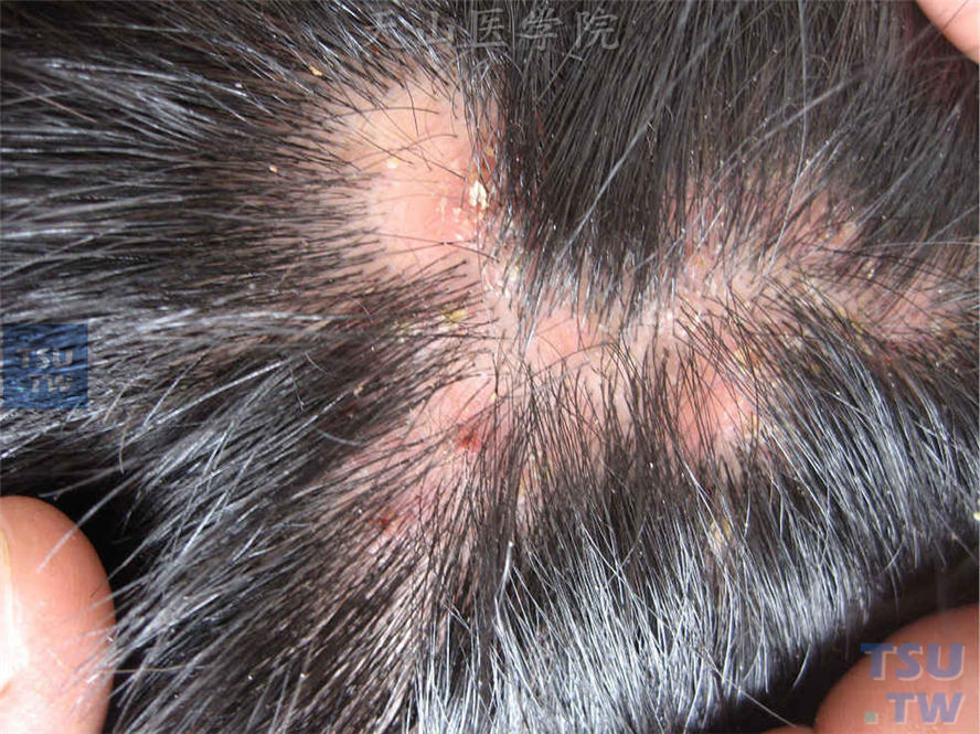 头皮不规则脱发区，基底红斑，毛囊性炎性丘疹、丘脓疱疹