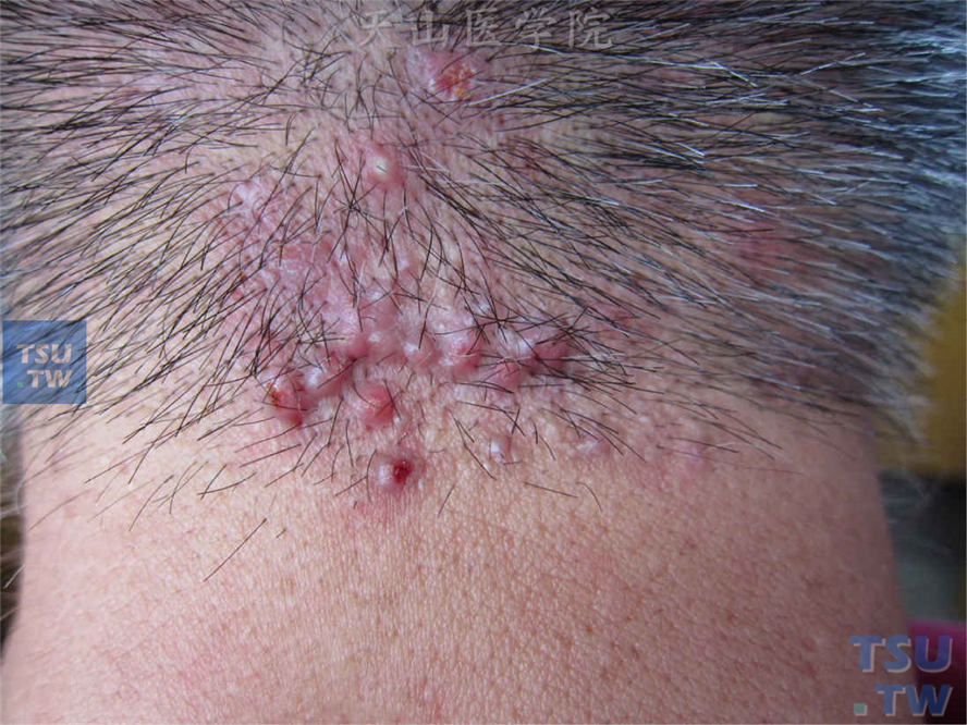 项部瘢痕疙瘩性毛囊炎（folliculitis keloidalis nuchae）颈项部毛囊性炎性丘疹、丘脓疱疹，瘢痕