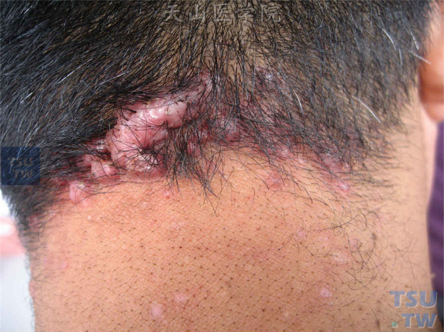颈项部毛囊性炎性丘疹基础上发生的圆形、条索状增生性瘢痕
