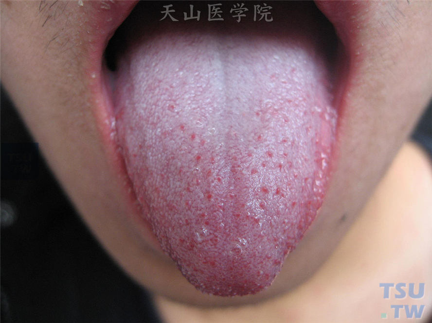 草莓舌：舌覆白苔，红肿的乳头突出于白苔之上