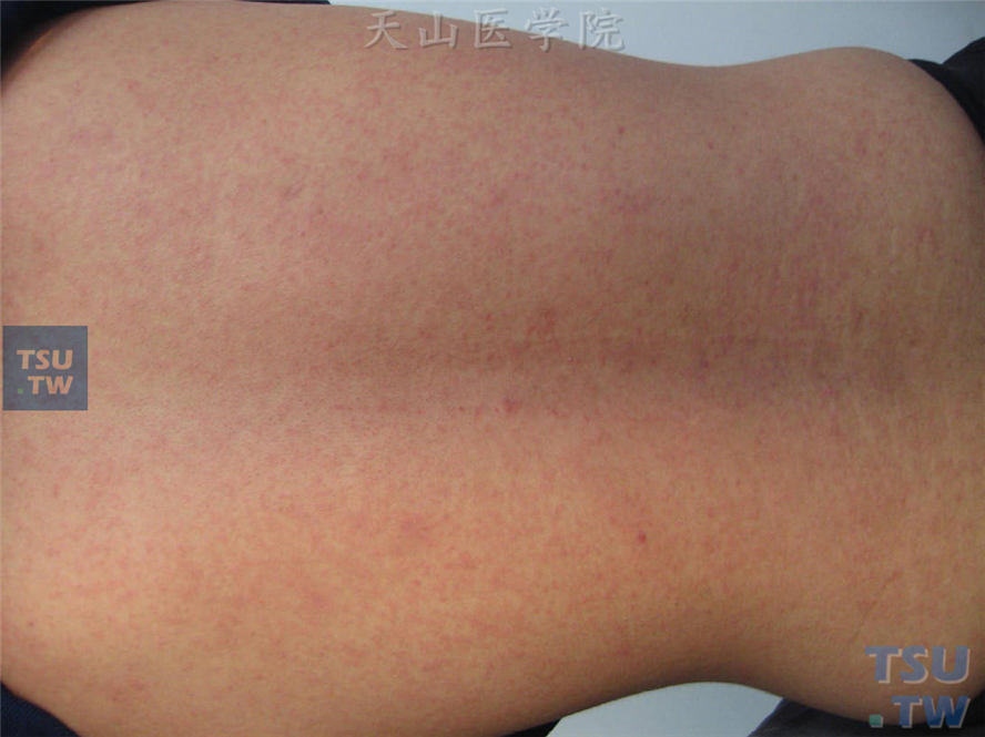 同一患者，后背部均匀分布的弥漫充血性针尖大小的丘疹，压之退色