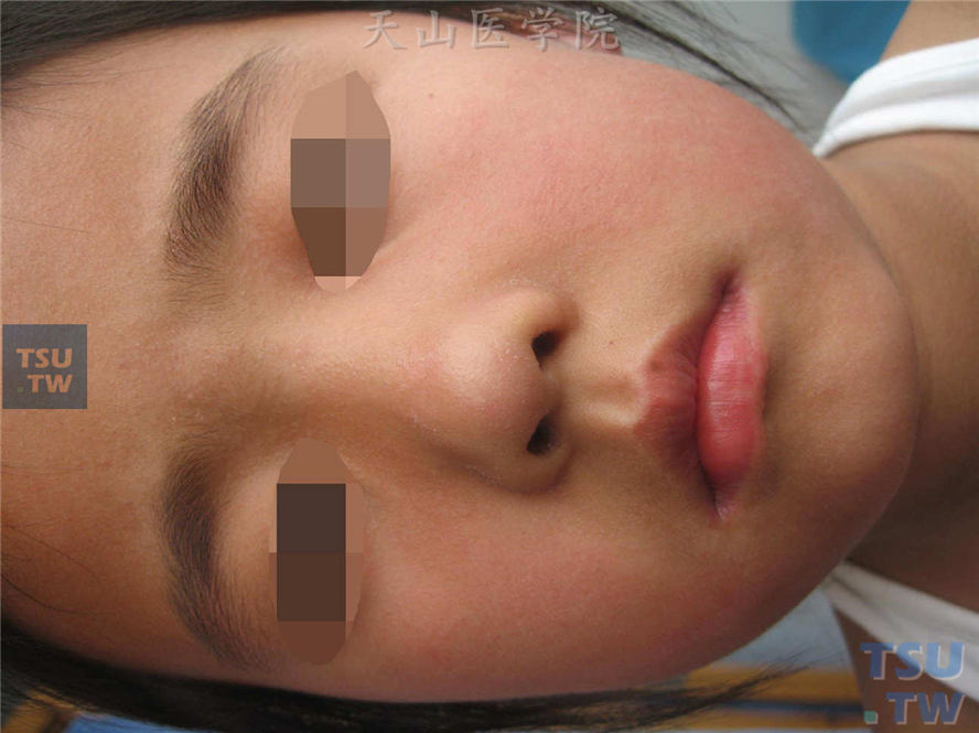 口周苍白圈：颜面部密集充血性皮疹，口鼻周围充血不明显，相比之下显得发白
