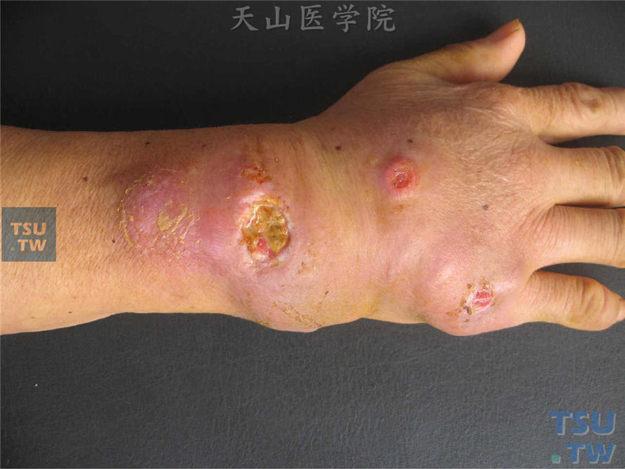 龟分枝杆菌感染：右侧手背、手腕背侧水肿性浸润性斑块，中央破溃成溃疡，基底凹凸不平，表面湿润，被覆黄色脓性坏死样物