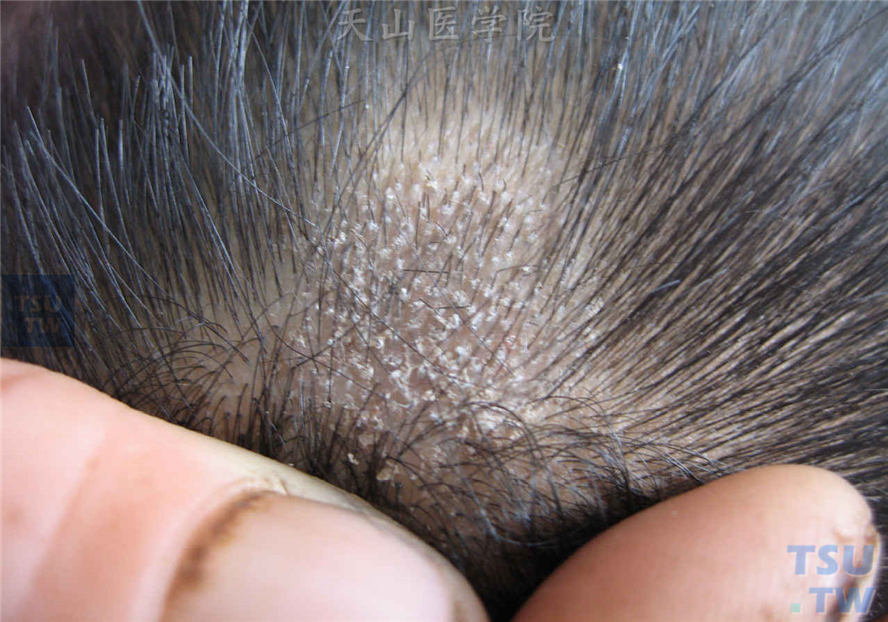 白癣：病发在距头皮2～4mm处折断，毛发根部有灰白色菌鞘包绕