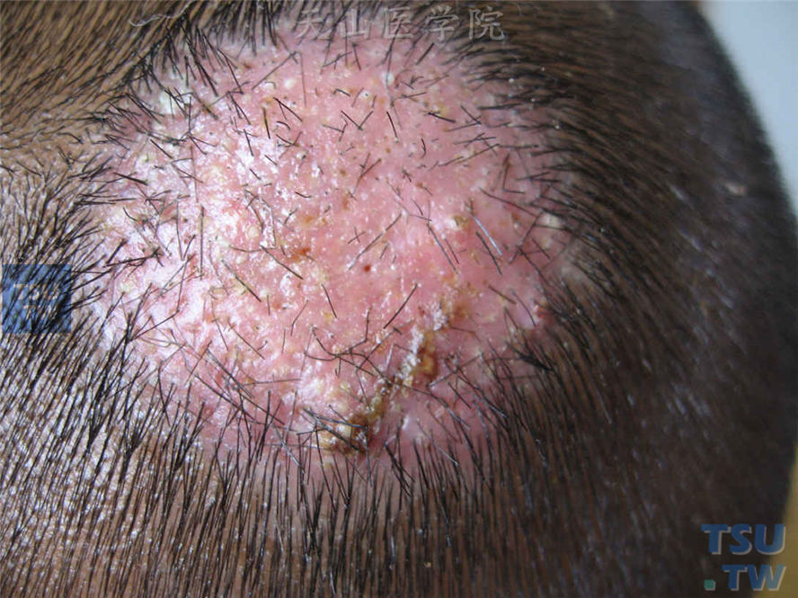 脓癣：头皮炎性肿块，表面粟粒大小脓疱，大部分头发脱落