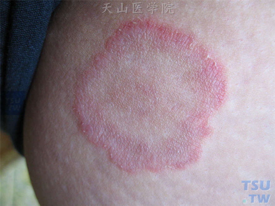 体癣：膝关节部位环状红斑，周边炎症明显，丘疹、脱屑，边界清楚
