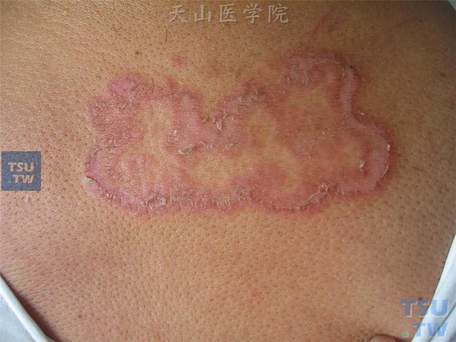 体癣（tinea corporis）的症状表现