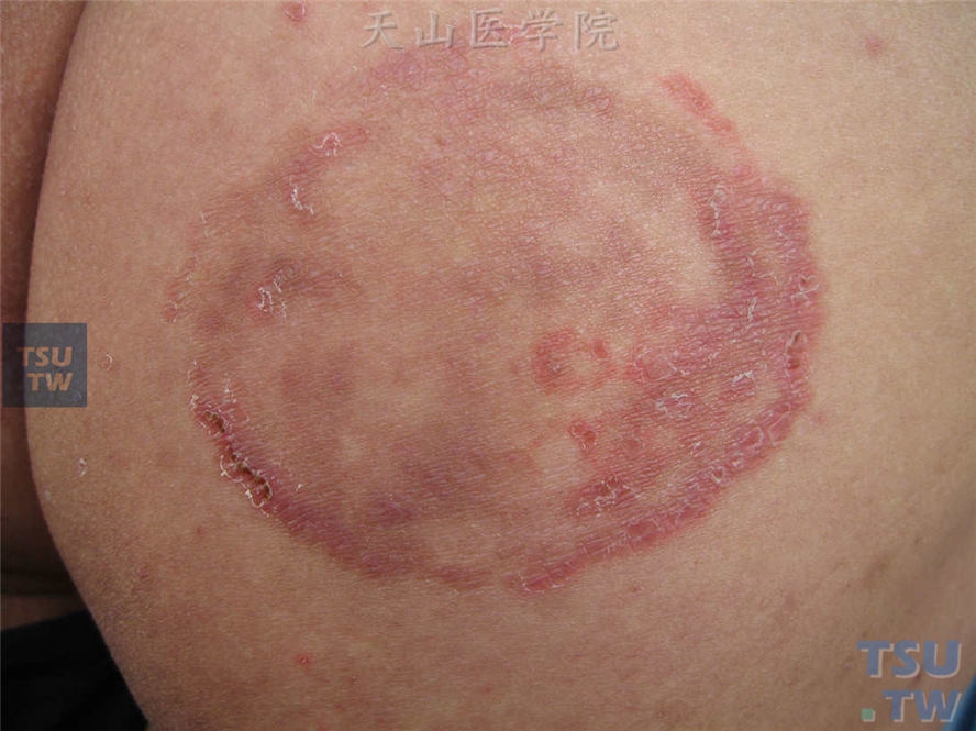 股癣：臀部圆形红斑、鳞屑性损害，边界清，边缘炎症显著