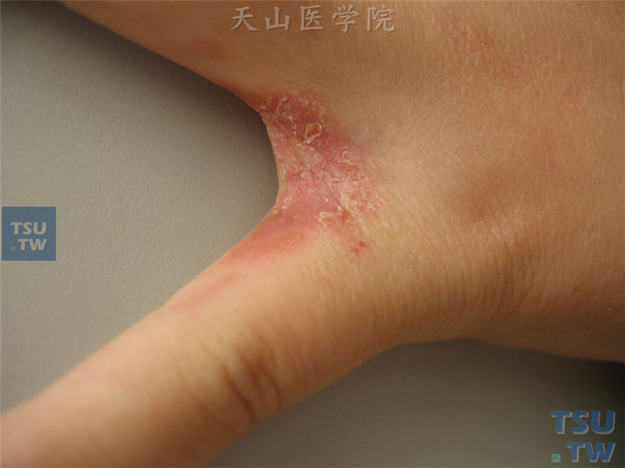 手癣：指间红斑、鳞屑，边缘针尖大小水疱，表面鳞屑