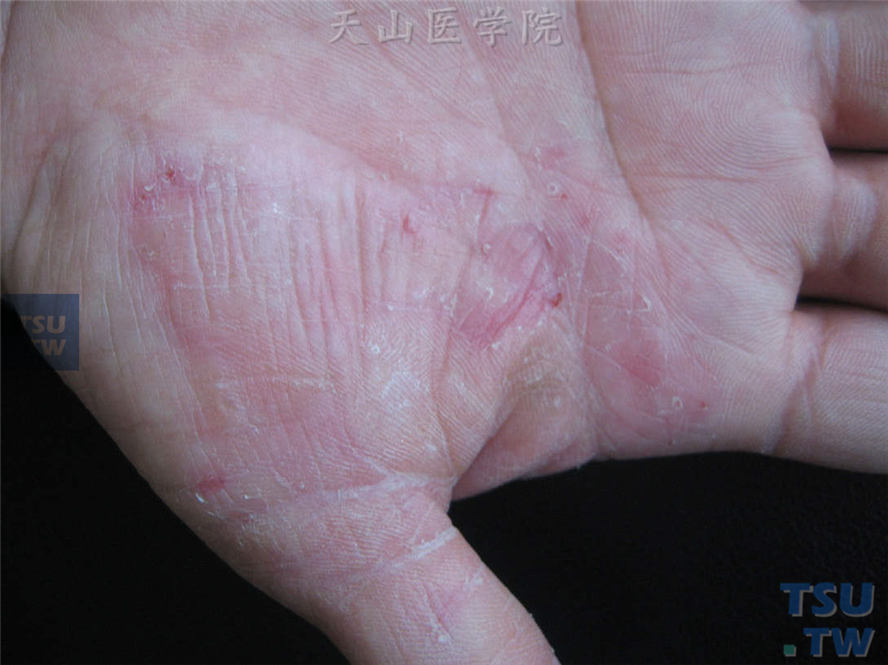 手癣：右手虎口区、大鱼际、拇指红斑、鳞屑，边缘散在针尖至粟粒大小丘疹、领圈状脱屑