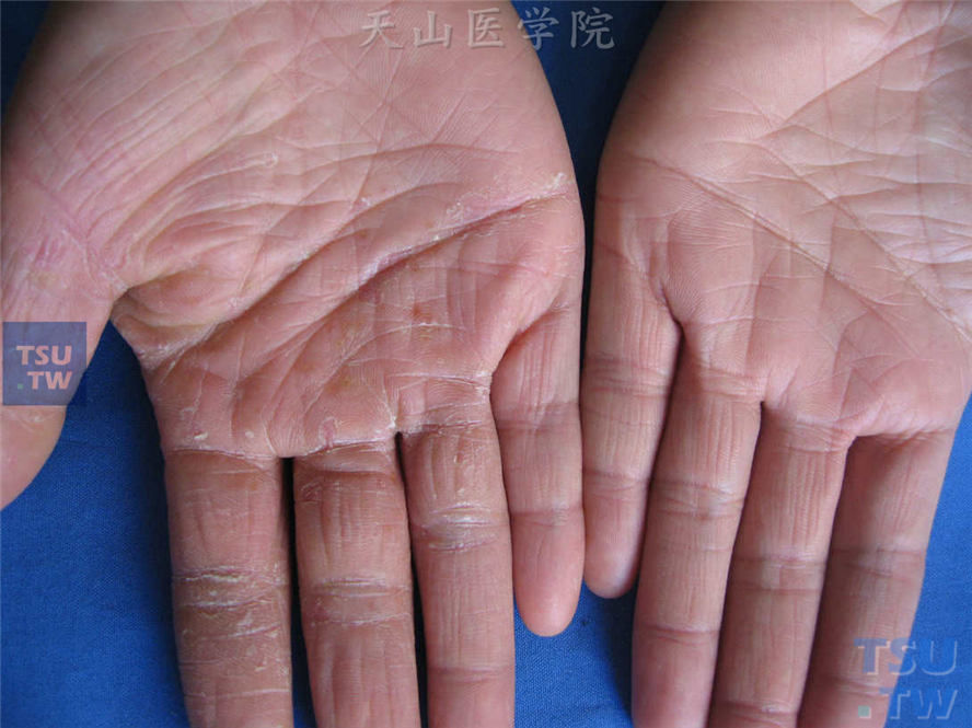 手癣：右手手掌、掌指关节屈侧皮肤粗糙，干燥性鳞屑，散在丘疹、水疱