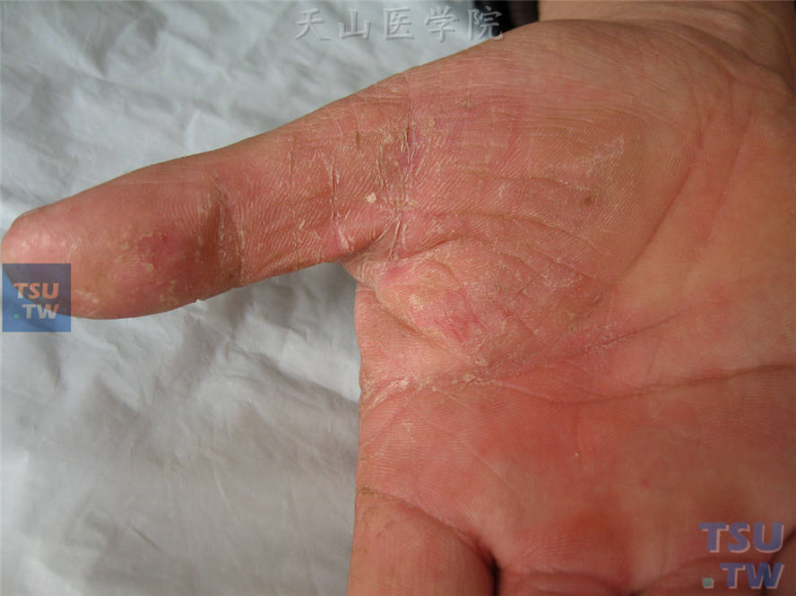 手癣：右手虎口区、大鱼际、拇指红斑，表面粘着性鳞屑