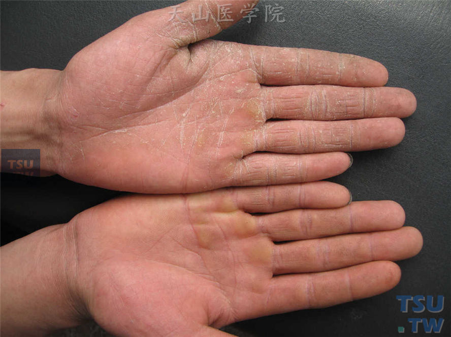 手癣：左手手掌、手指掌侧皮肤粗糙，粘着性鳞屑，线状皲裂