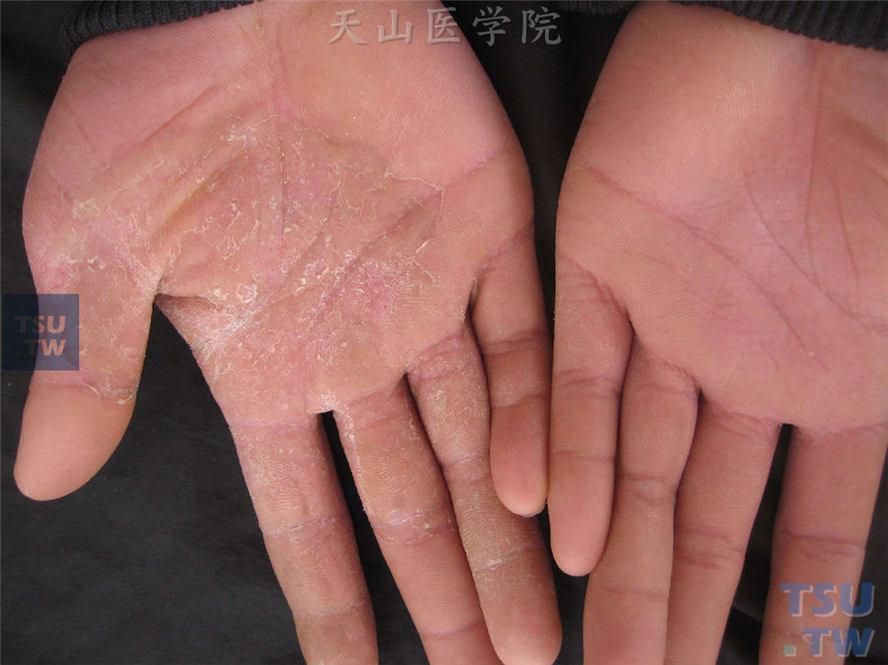 手癣（tinea manus）的症状表现