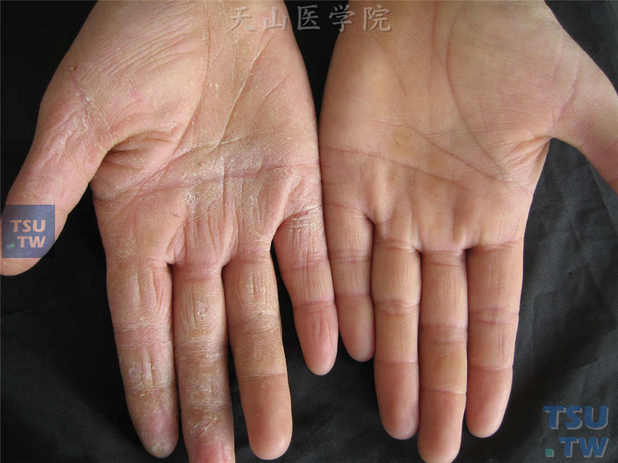 手癣：右手手掌、手指掌侧角化过度，干燥粗糙