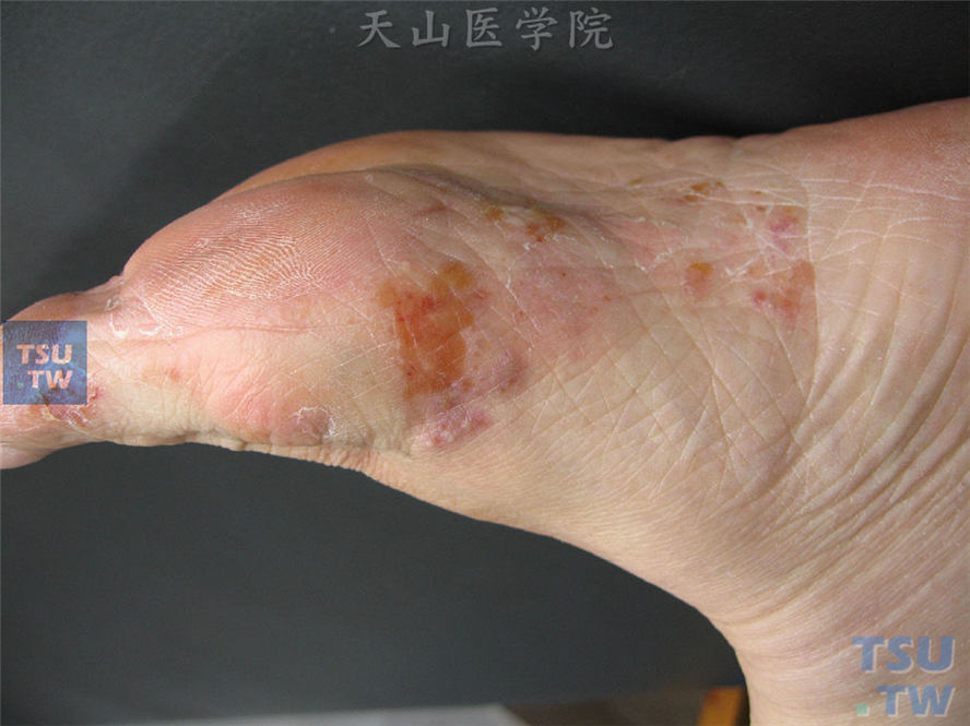 足癣：水疱鳞屑型：足跖、足侧缘针尖至粟粒大小深在性水疱，部分呈多房性，其上领圈状脱屑
