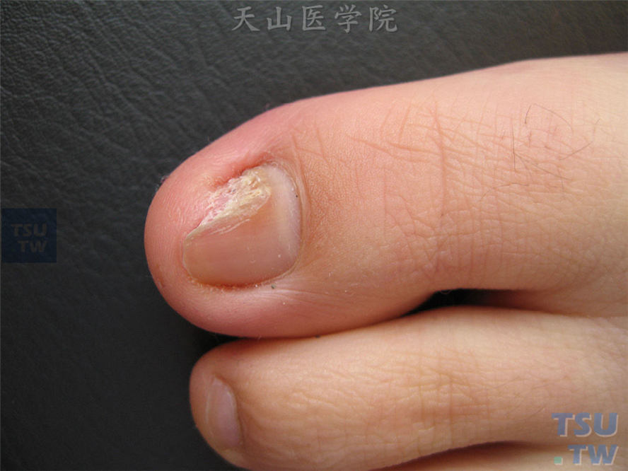 甲真菌病（onychomycosis）的症状表现