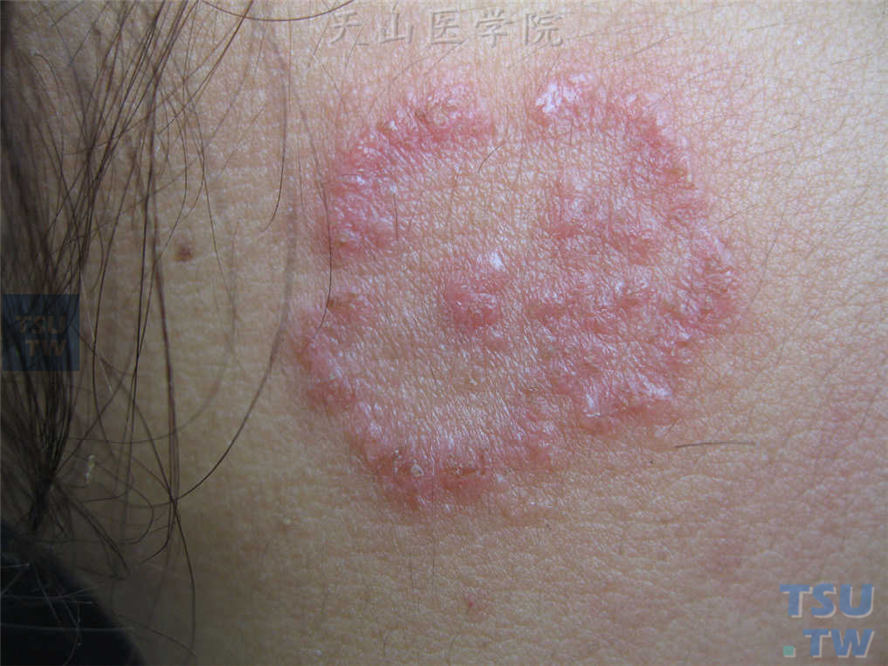 右侧面颊环形红斑，边缘呈水肿性，密集丘疹、丘疱疹，边界清楚
