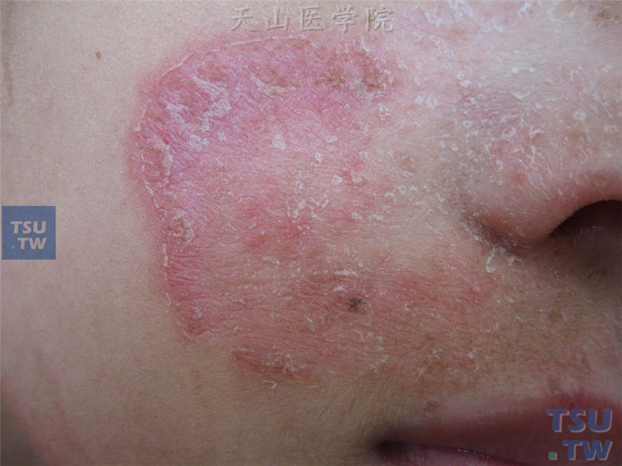 右侧面颊及鼻周半环形红斑，边缘炎症明显，被覆薄层鳞屑，界清