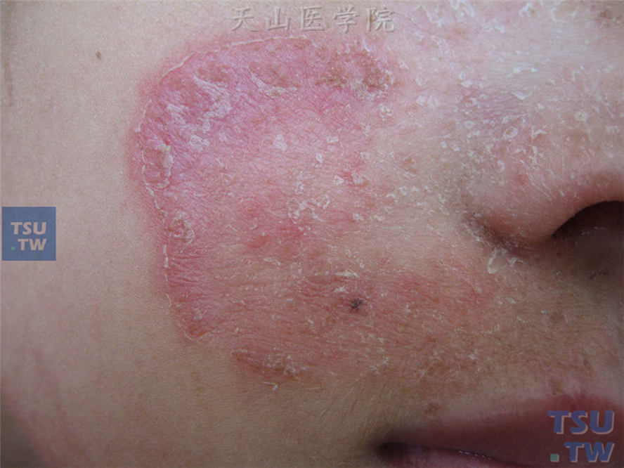 面癣(tinea facial)的症状表现 