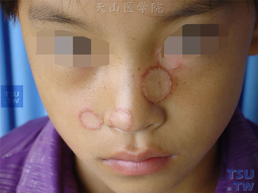 面癣（tinea facial）的症状表现