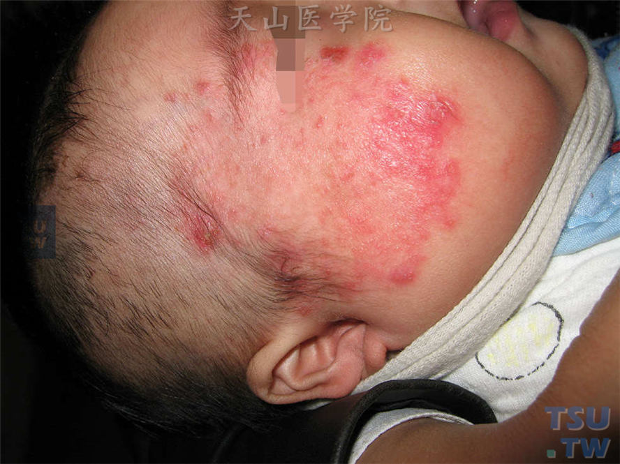 婴儿面部类圆形红斑，边缘丘疹、水疱，边界欠清