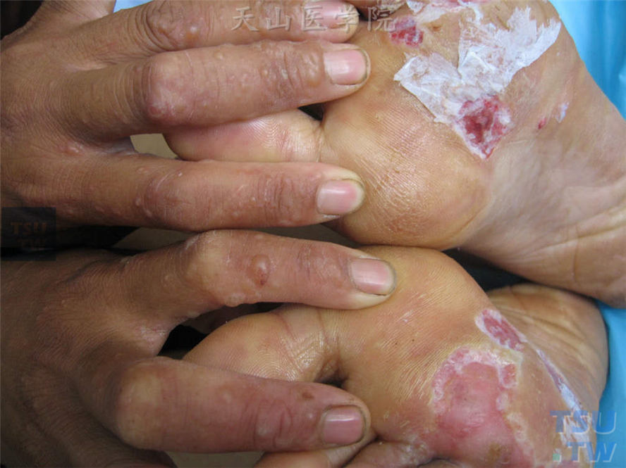 足癣感染后炎症加重，7天后手背发生水疱